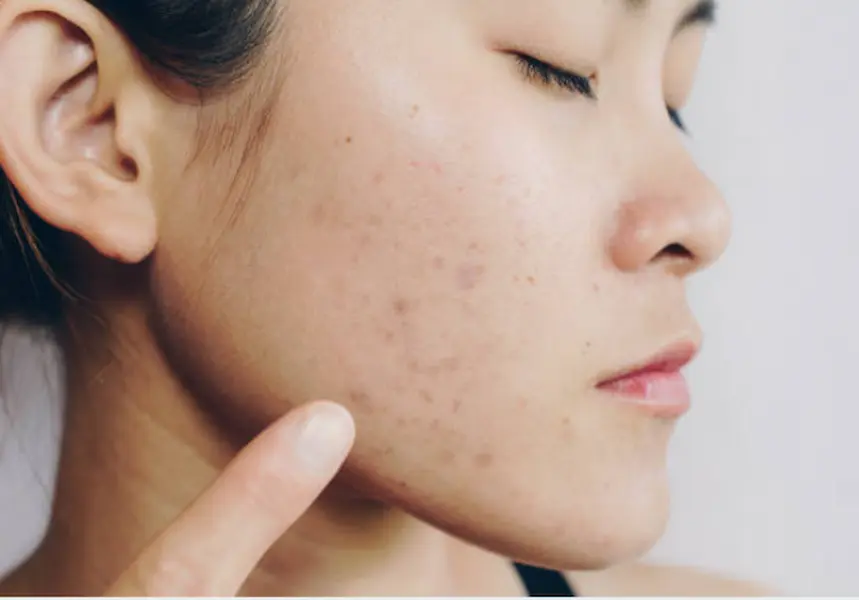 Post inflammatoire hyperpigmentatie - PIH