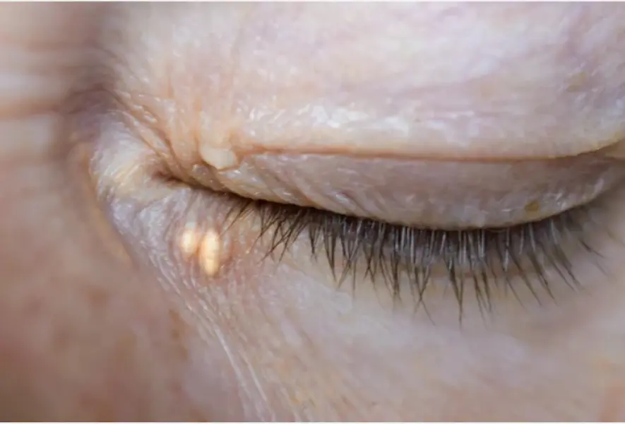 Xanthelasma Huidskills Kliniek