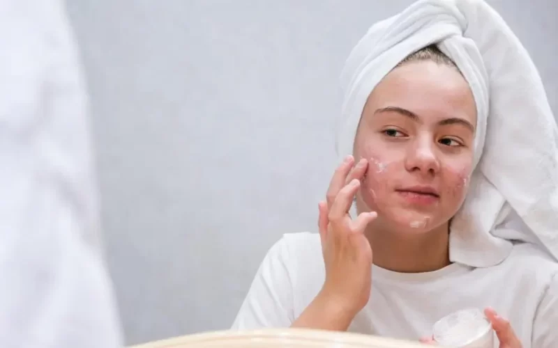 Acne blog Huidskills Kliniek