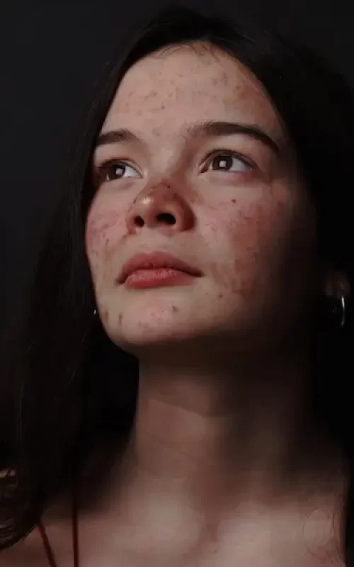 Acnelittekens Huidskills Kliniek