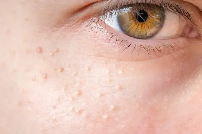 Gerstenkorrels (milia) rondom de ogen