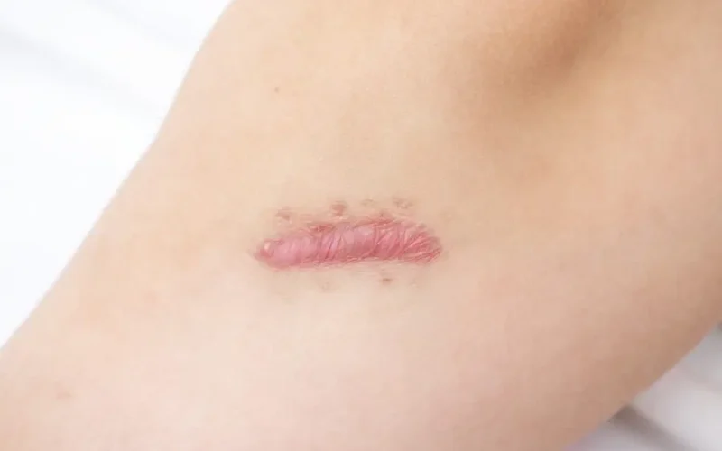 Normale - atrofische littekens Huidskills Kliniek