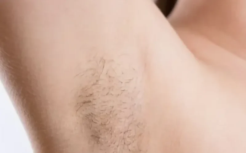 Ongewenst Haargroei Huidskills Huidkliniek