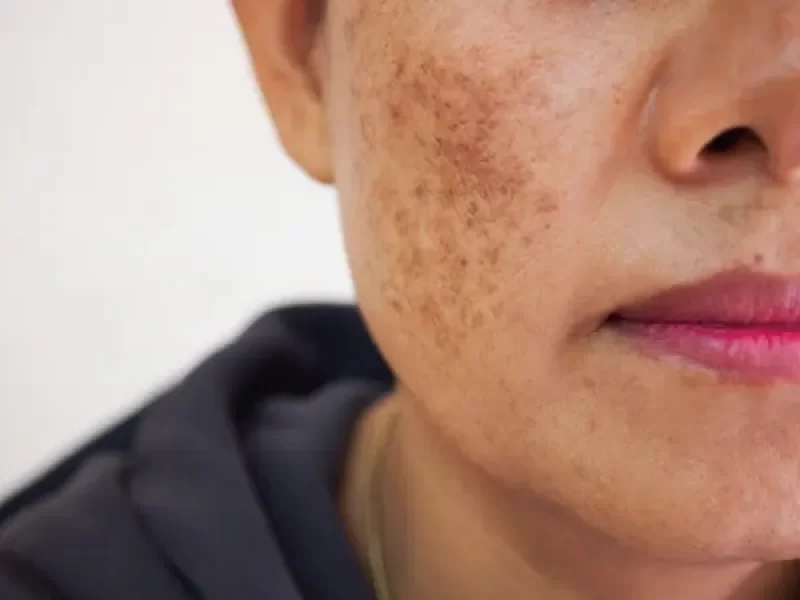 Pigmentvlekken Melasma Huidskills Huidkliniek