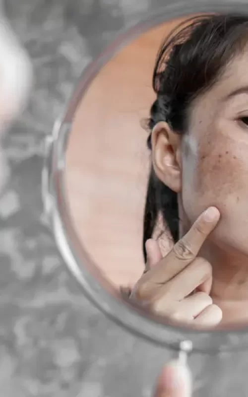 Pigmentvlekken Huidskills Kliniek